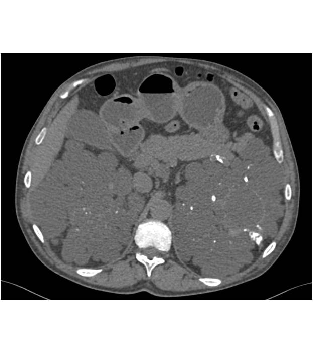 Polycystic Kidneys with Renal Calcifications and Multiple Cysts - CTisus CT Scan