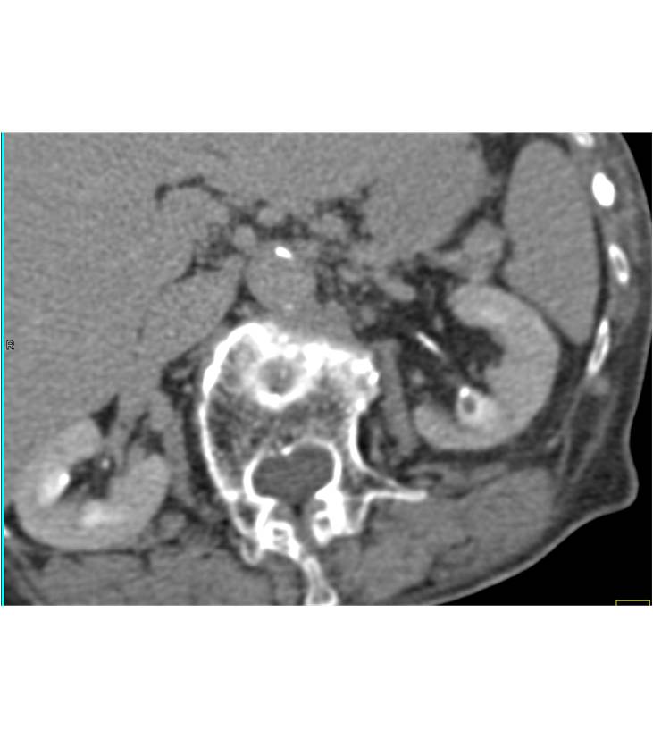 Non-Opaque Stone in Calyx - CTisus CT Scan