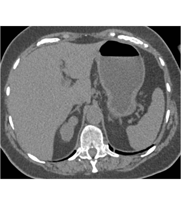 Renal Cell Carcinoma (1 cm) - CTisus CT Scan