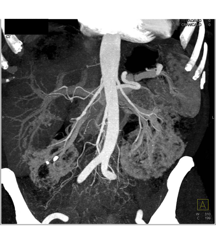 Polycystic Kidney and Polycystic Liver Disease - CTisus CT Scan