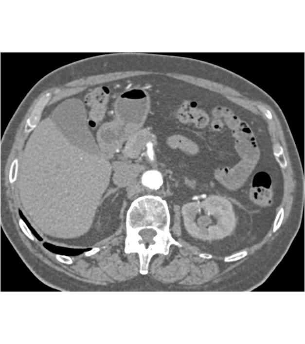 Transitional Carcinoma of the Upper Pole Calyx of the Left Kidney - CTisus CT Scan