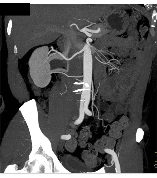 Renal Donor with Two Right Renal Arteries and Veins. - CTisus CT Scan