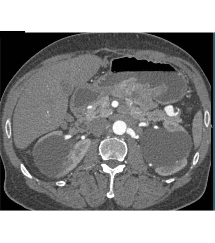 Renal CTA with Incidental Splenic Artery Aneurysm - CTisus CT Scan