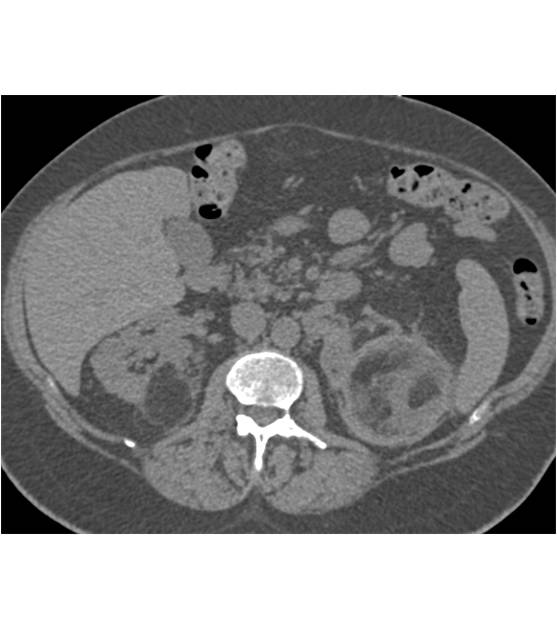 Bilateral Renal Angiomyolipomas - CTisus CT Scan