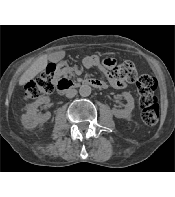 Vascular 3 cm Right Renal Cell Carcinoma - CTisus CT Scan