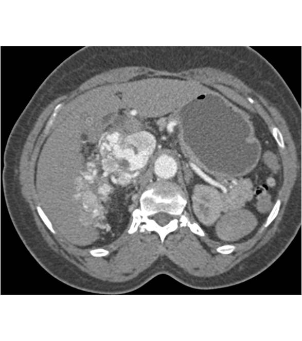 Vascular Renal Cell Carcinoma with Neovascularity and Tumor Extension into Renal Vein, Inferior Vena Cava (IVC) and Right Atrium - CTisus CT Scan