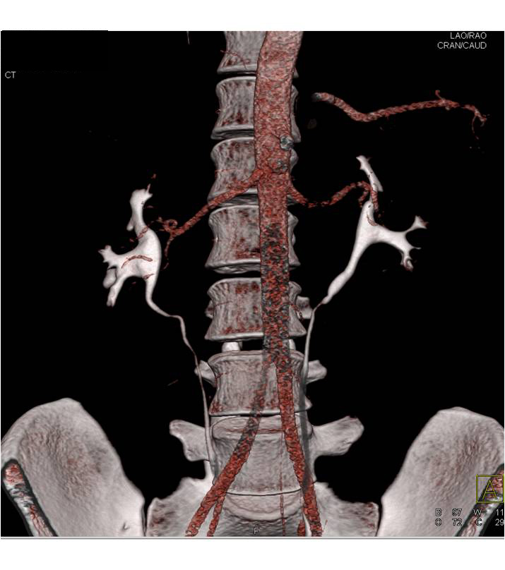 Composite Imaging With Early Injection and 3 Minute Delay with Combined Arterial Phase Imaging - CTisus CT Scan