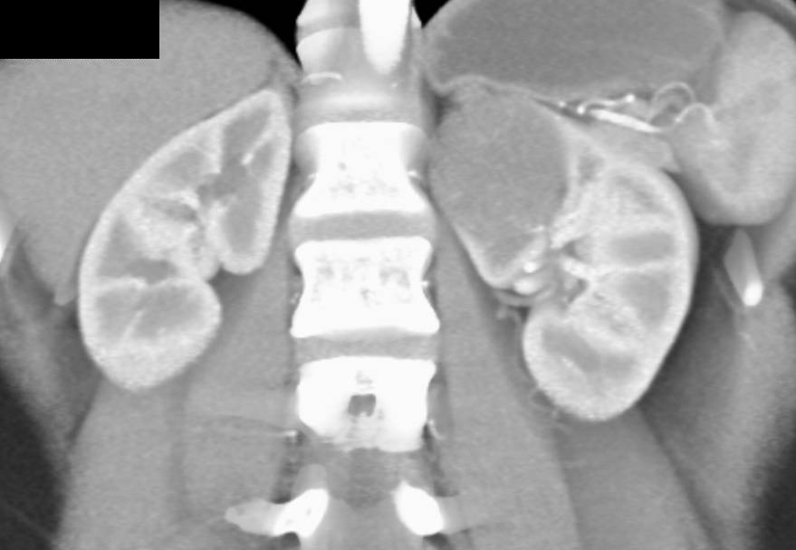 Cystic Renal Cell Carcinoma - CTisus CT Scan