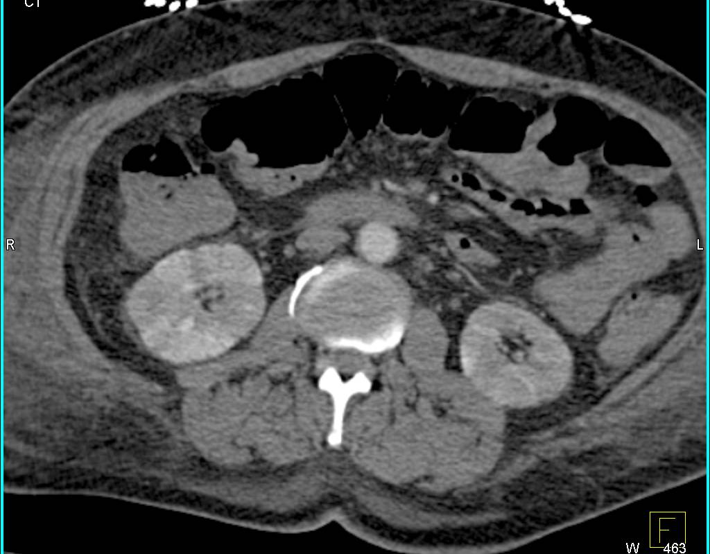 CS in Left Renal Pelvis in Kidneys with Patchy Enhancement of the kidney - CTisus CT Scan