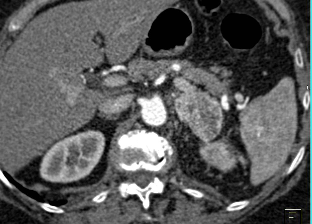 Vascular Left Renal Cell Carcinoma Extends into the Left Renal Vein - CTisus CT Scan