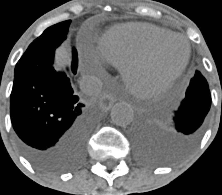 Constrictive Pericarditis and End Stage Renal Disease with Periportal Edema in the Liver - CTisus CT Scan