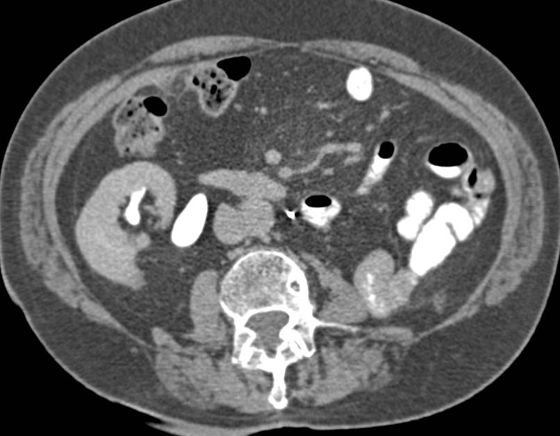 Normal Left Nephrectomy Bed - CTisus CT Scan