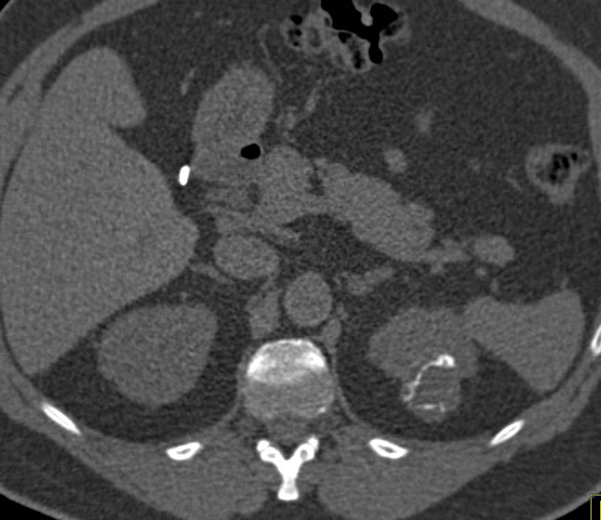 Bosniak 2F Cyst Left Kidney - CTisus CT Scan