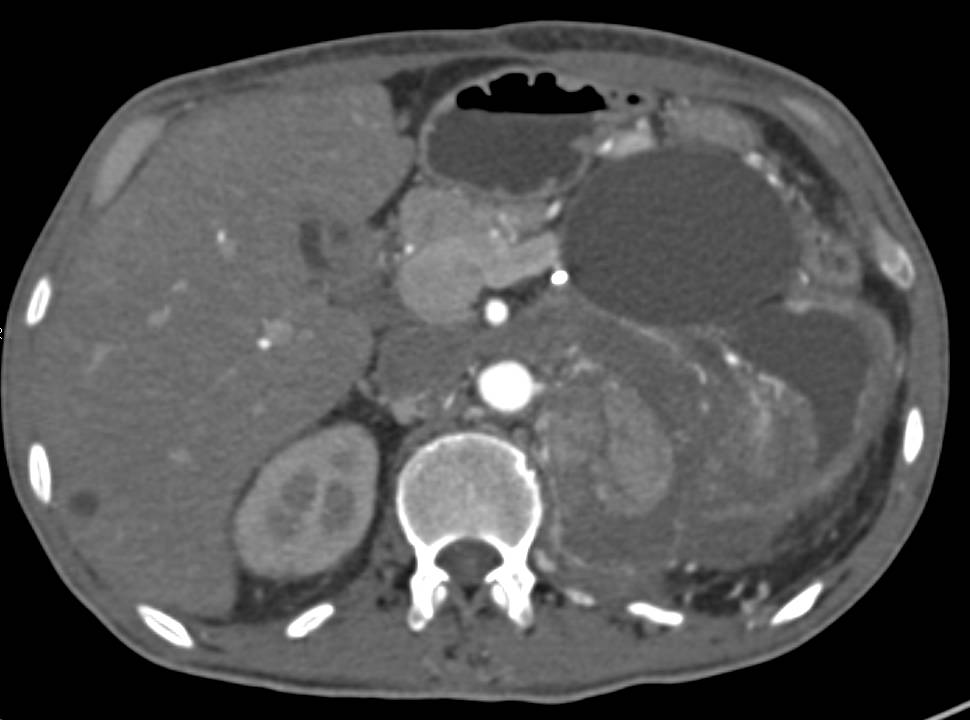 Aggressive Clear Cell Carcinoma Left Kidney with Inferior Vena Cava (IVC) Extension and Extensive Collaterals - CTisus CT Scan