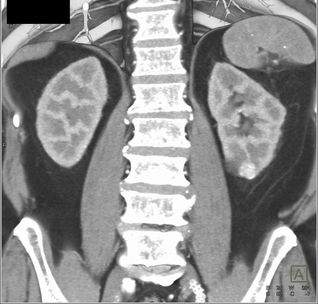 1 cm Left Renal Cell Carcinoma - CTisus CT Scan