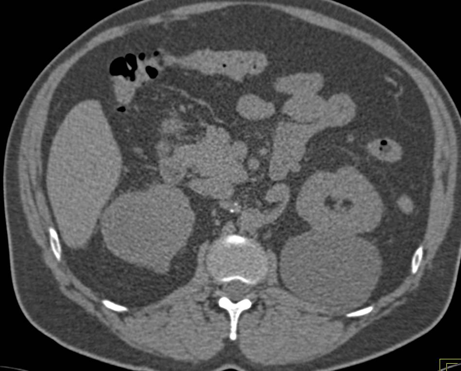 Bilateral Renal Cell Carcinoma with CT Urography - CTisus CT Scan