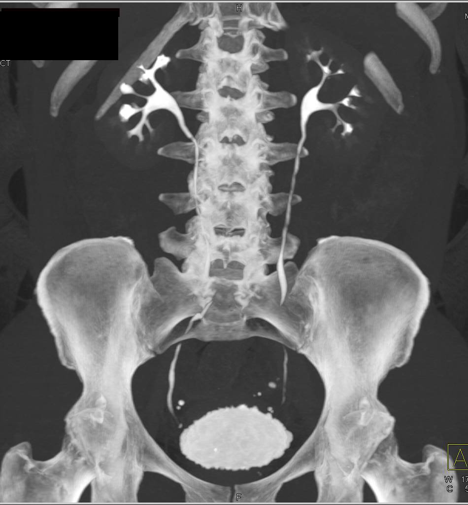 Cystitis - CTisus CT Scan