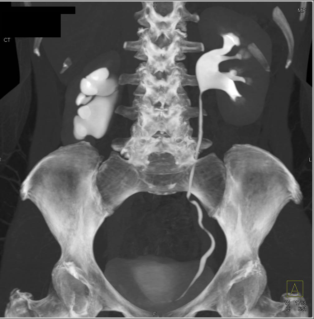 Ureteropelvic Junction (UPJ) Obstruction of the Right Kidney - CTisus CT Scan