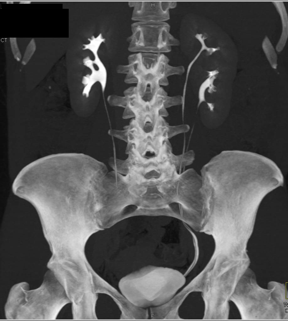 Duplicated Collecting System of the Left Kidney - CTisus CT Scan