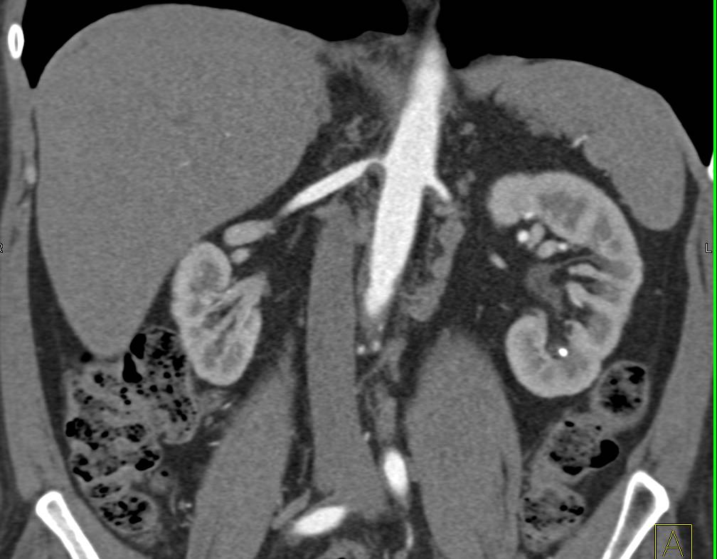 High Grade Stenosis of the Upper Right Renal Artery - CTisus CT Scan