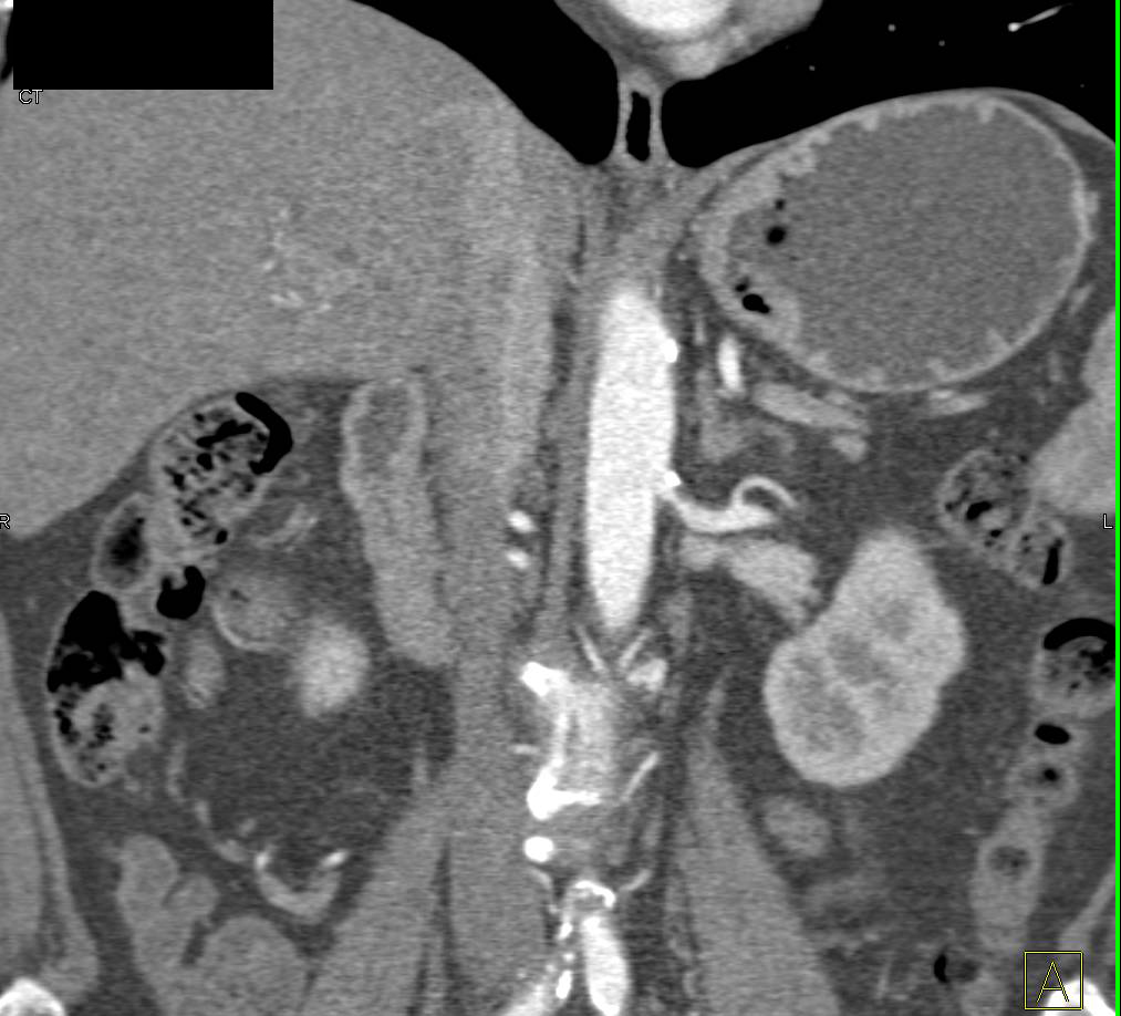 Critical Stenosis of the Left Renal Artery - CTisus CT Scan