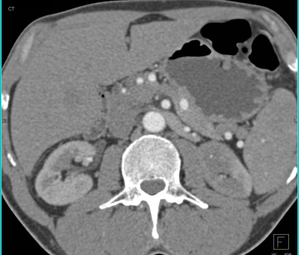 Infarct in the Upper Pole of the Left Kidney - CTisus CT Scan