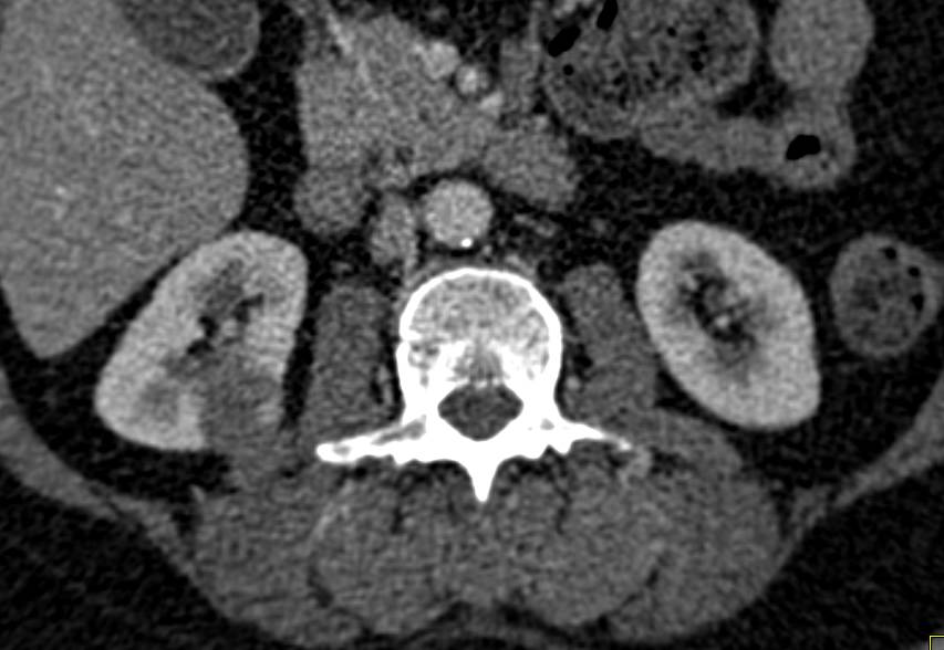 High Density Renal Cyst - CTisus CT Scan