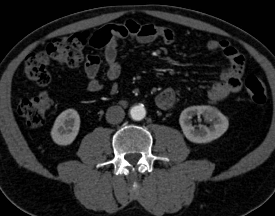 Subtle Hypovascular Left Renal Cell Carcinoma - CTisus CT Scan