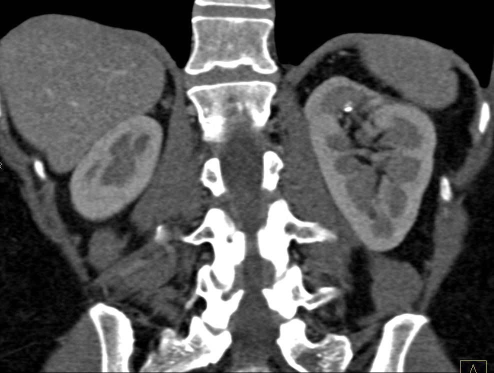 Stone Upper Pole Left Kidney with Scarring of the Kidney - CTisus CT Scan