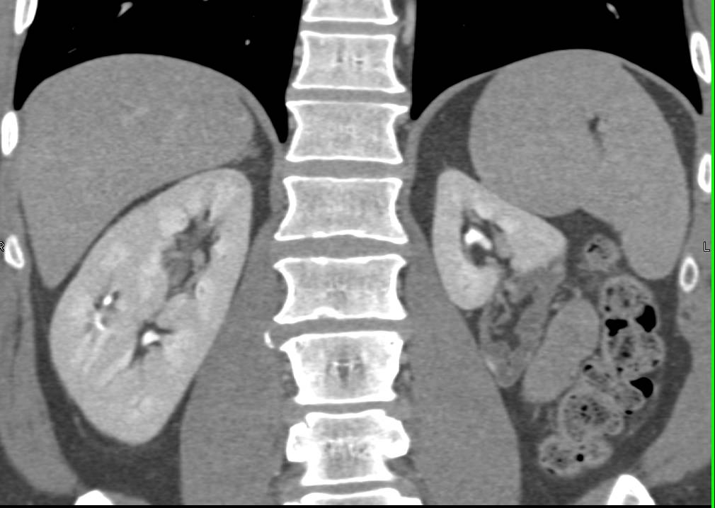 Infarct of Lower Pole of Left Kidney - CTisus CT Scan