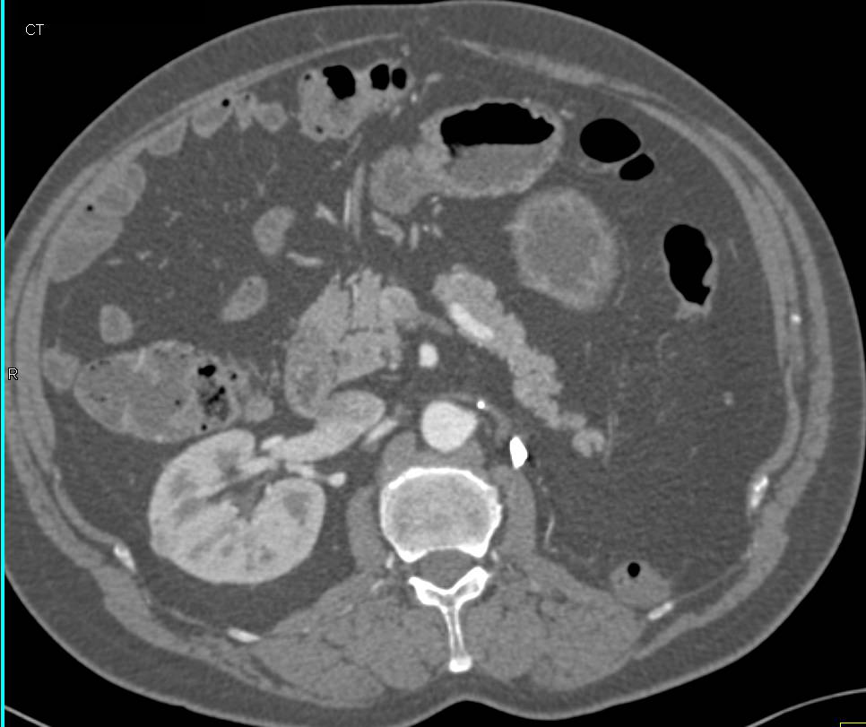 Normal Left Nephrectomy Bed - CTisus CT Scan