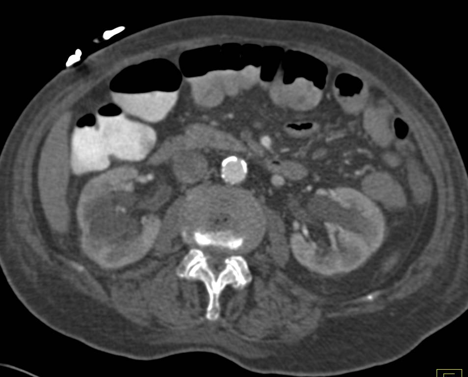 Acute Pyelonephritis Involving Left Kidney - CTisus CT Scan