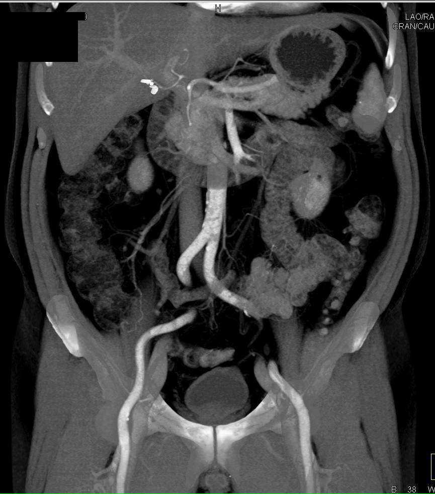 Left Renal Ureteropelvic Junction (UPJ) due to Crossing Vessels in Multiple 3D Renderings - CTisus CT Scan