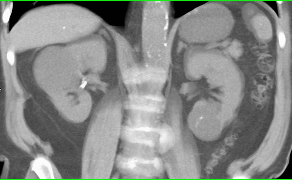 1 cm Renal Cell Carcinoma in Lower Pole of Left Kidney with Renal Cysts - CTisus CT Scan