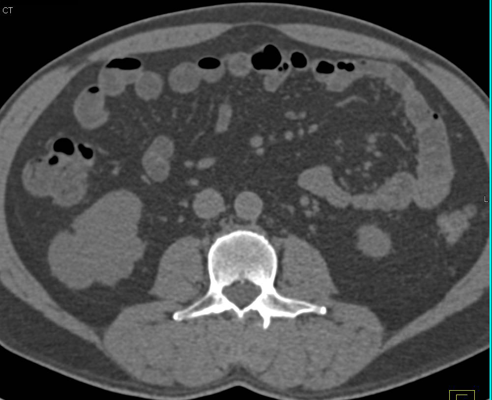 Complex Cyst in the Lower Pole of the Right Kidney with Septations but no Abnormal Enhancement - CTisus CT Scan