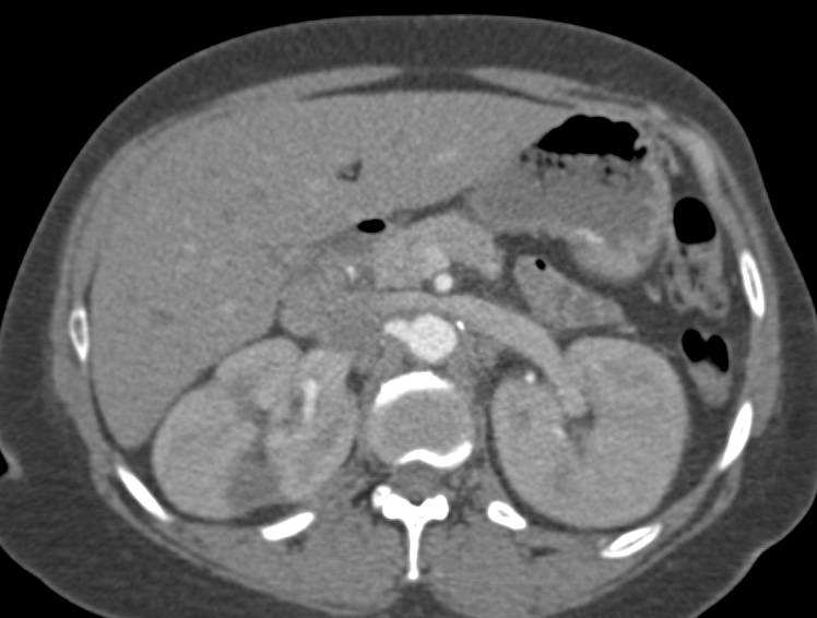 Acute Pyelonephritis Involving Both Kidneys - CTisus CT Scan