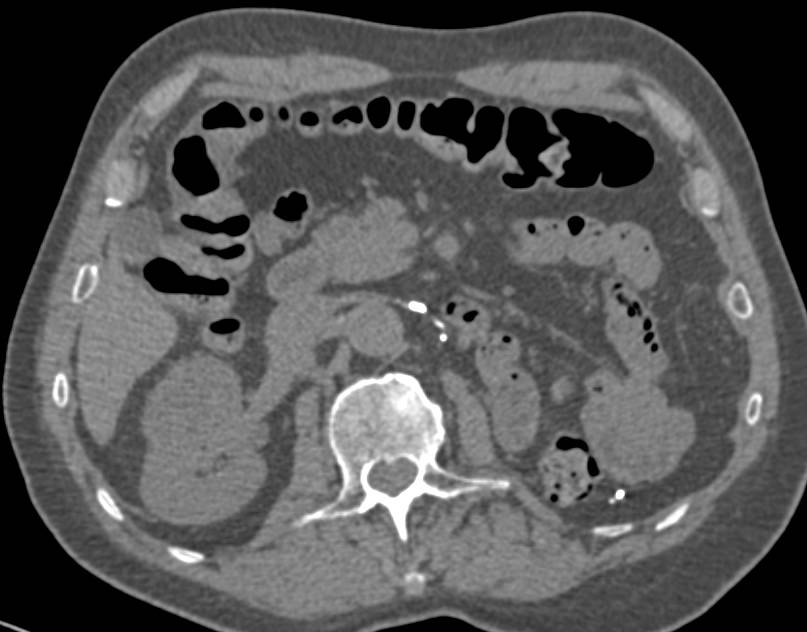 Left Renal Bed s/p Nephrectomy - CTisus CT Scan