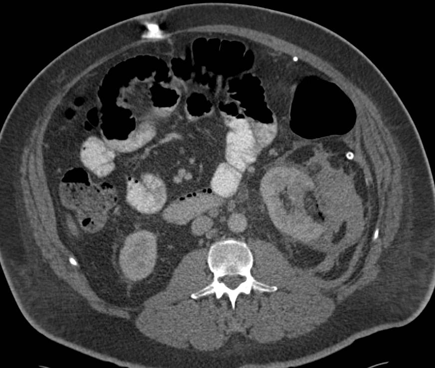 Perirenal Hematoma s/p Partial Nephrectomy - Kidney Case Studies ...