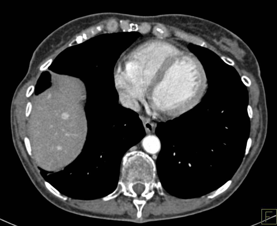 Metastatic Renal Cell Carcinoma with Enhancing Necrotic Nodes and Liver Metastases and Prior Right Nephrectomy - CTisus CT Scan