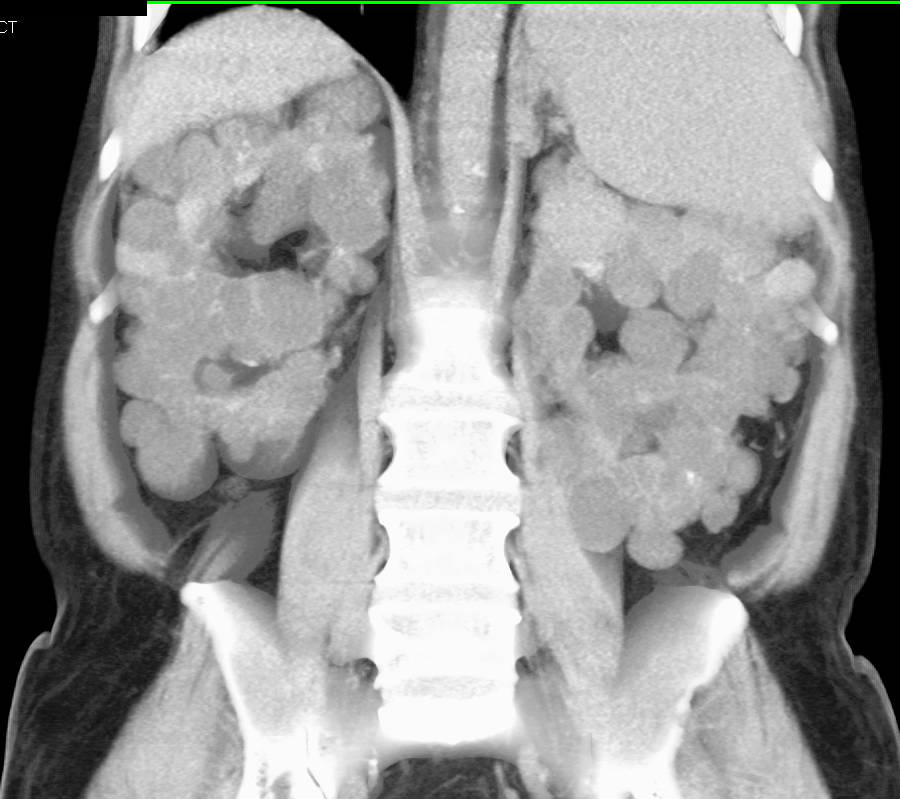 Polycystic Kidneys with Renal Calcifications and Multiple Cysts and Renal Transplant - CTisus CT Scan