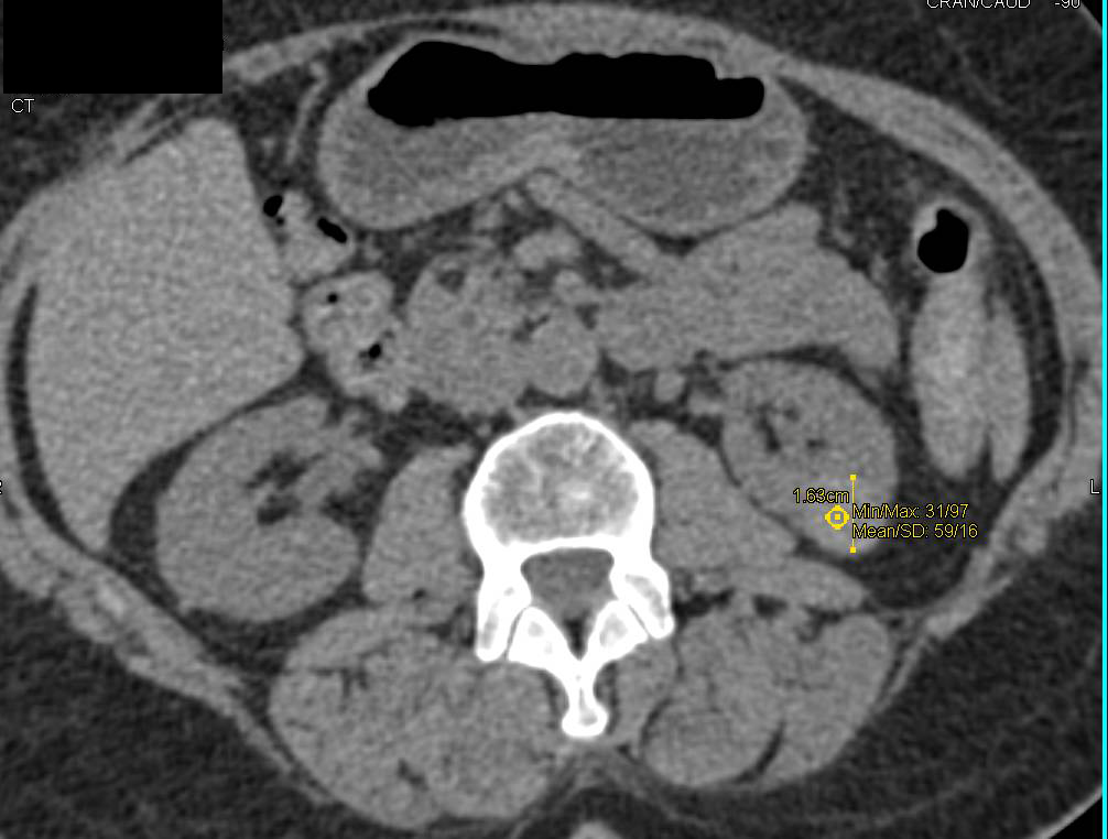 High Density Renal Cyst with Multiple Phases and Displays - CTisus CT Scan