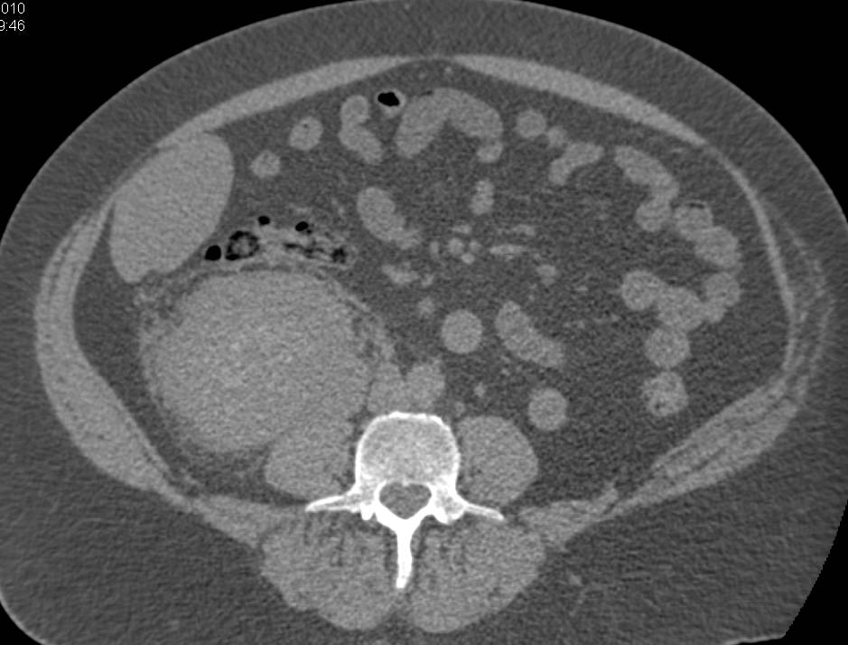 Renal Cell Carcinoma Extends into Renal Vein and Inferior Vena Cava (IVC) - CTisus CT Scan