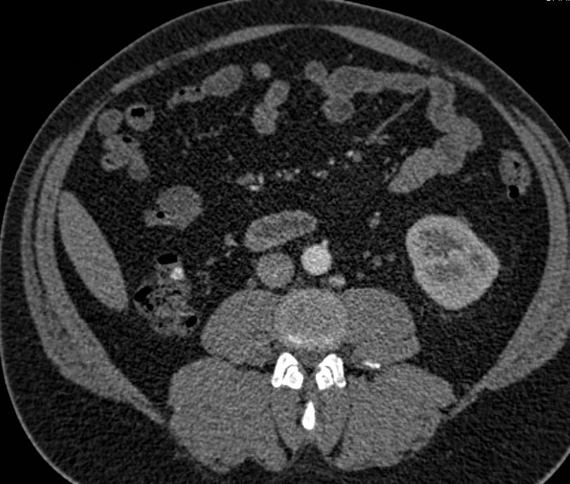 Stool in Colon Simulates Recurrent Renal Cell Carcinoma in Right Renal Fossa - CTisus CT Scan