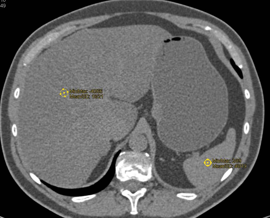 High Density Cyst Left Kidney in Multiple Phases. Patient also has Fatty Liver. - CTisus CT Scan