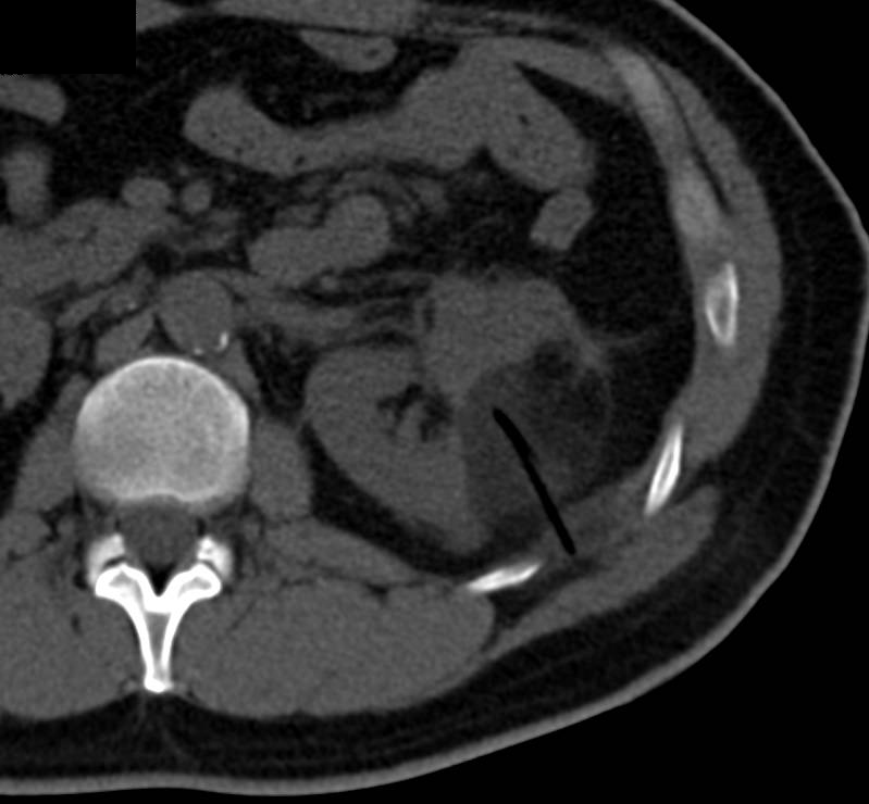 Post Ablation CT of Renal Cell Carcinoma - CTisus CT Scan