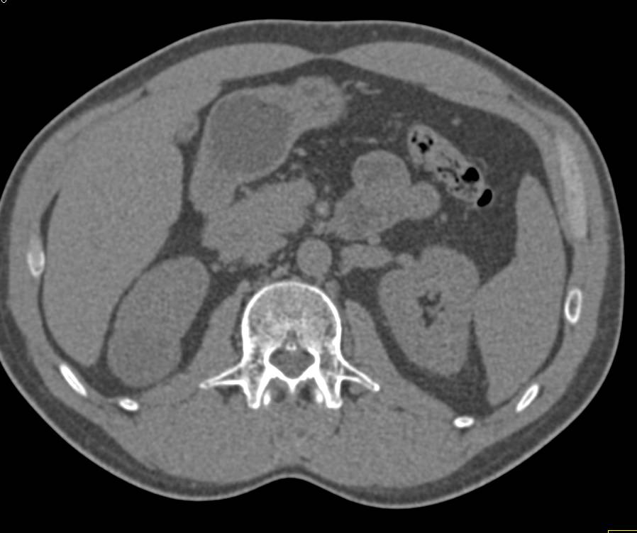 Papillary Renal Cell Carcinoma in Multiple Displays - CTisus CT Scan