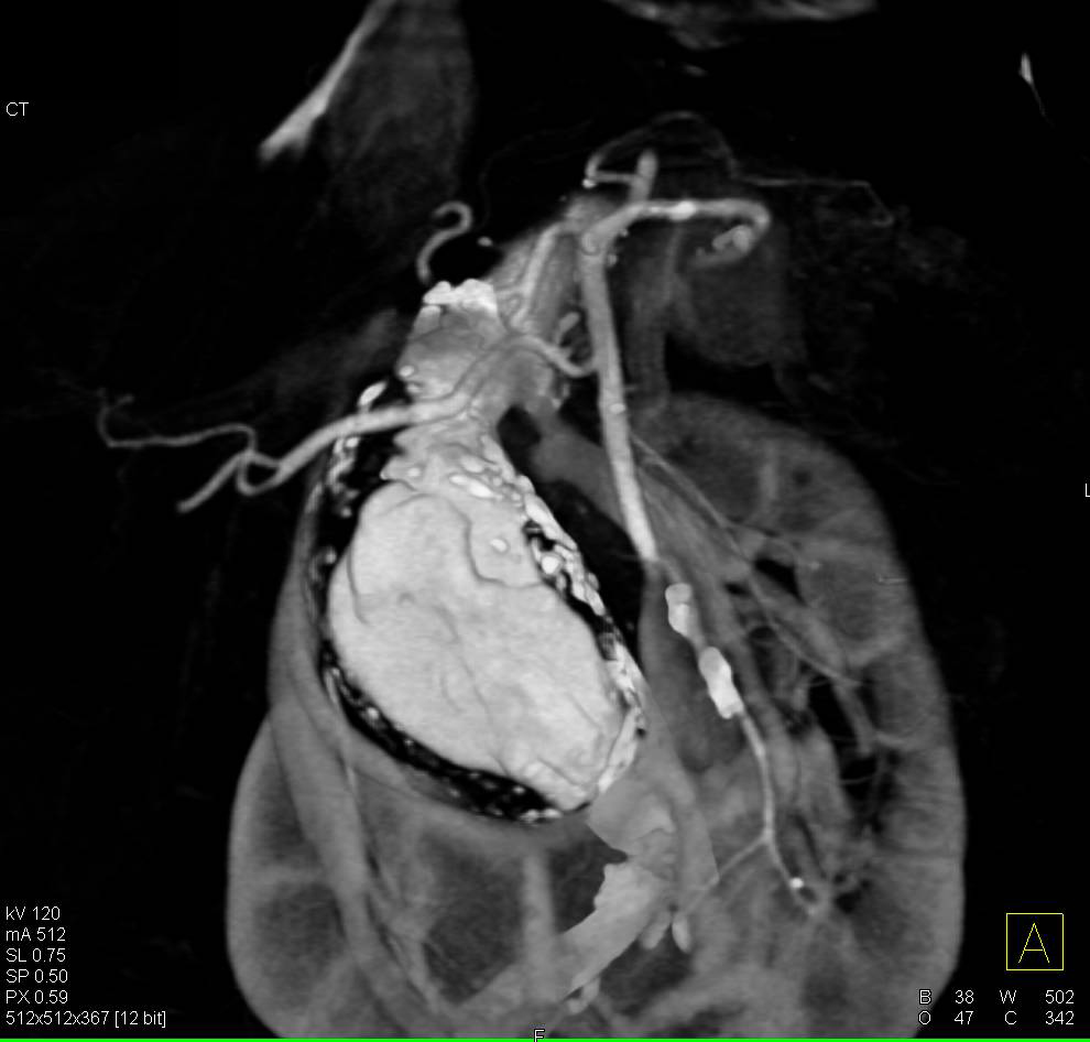Horseshoe Kidneys in a Patient with an Aortic Aneurysm - CTisus CT Scan
