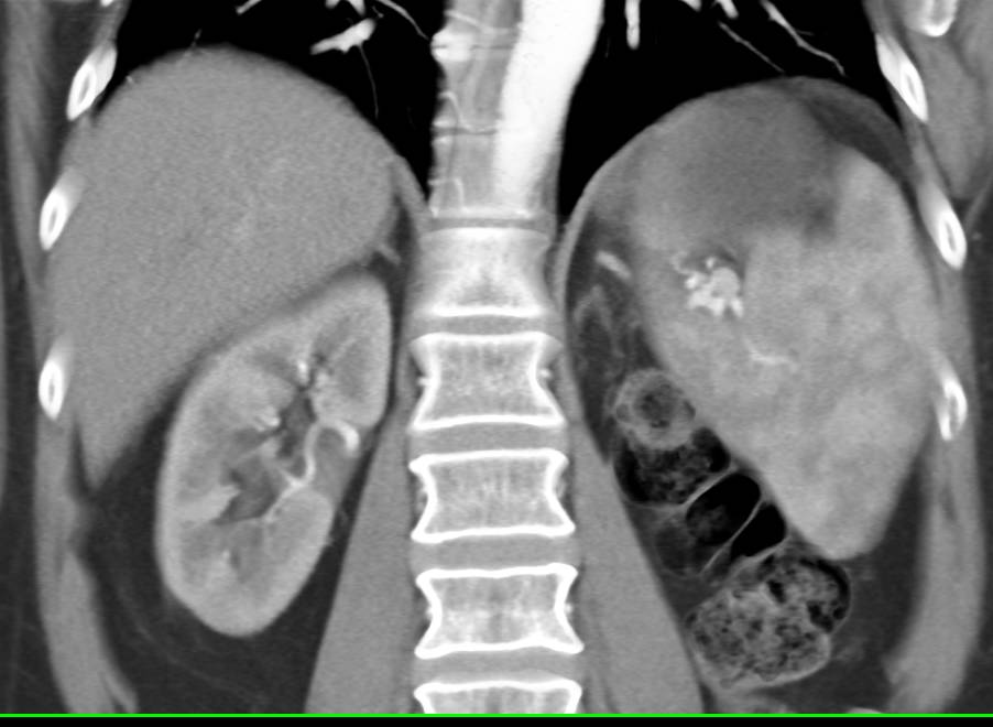 Recurrent Renal Cell Carcinoma Metastatic to the Lymph Nodes Near and Around the Pancreas - CTisus CT Scan