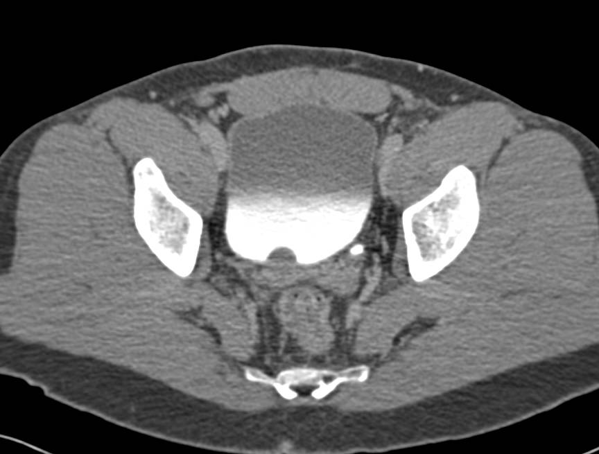 Chronic Pyelonephritis with Blunted Calyces - CTisus CT Scan
