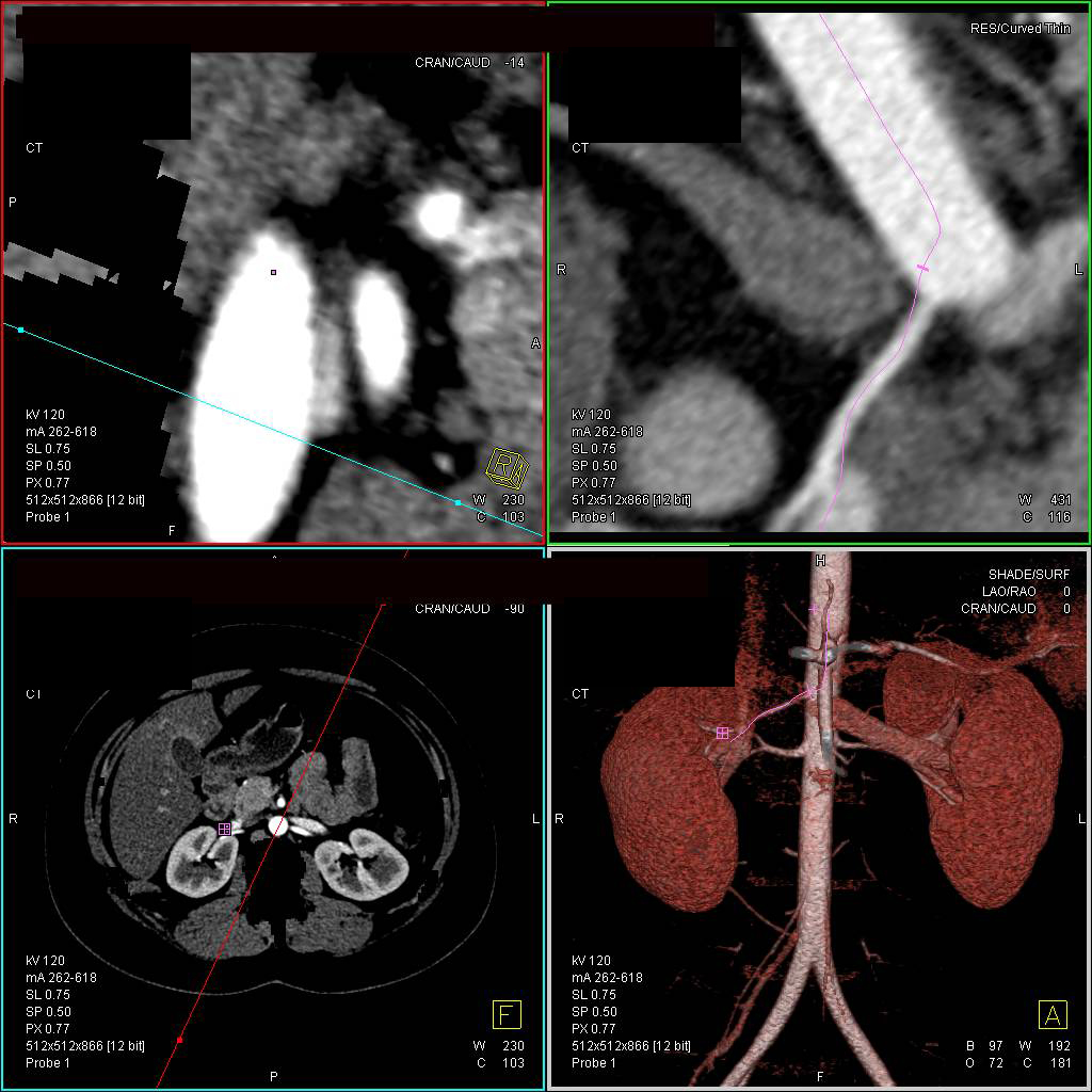 Vascular Mapping of the Renal Arteries - CTisus CT Scan